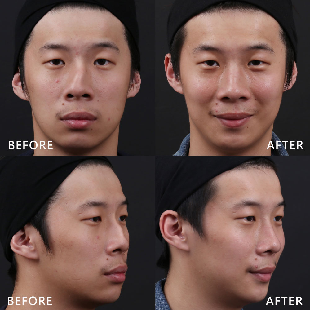 Four-panel collage of a young man: before (front view top-left, left profile bottom-left) and after (front view top-right, left profile bottom-right; shows clearer, more even skin after treatment).