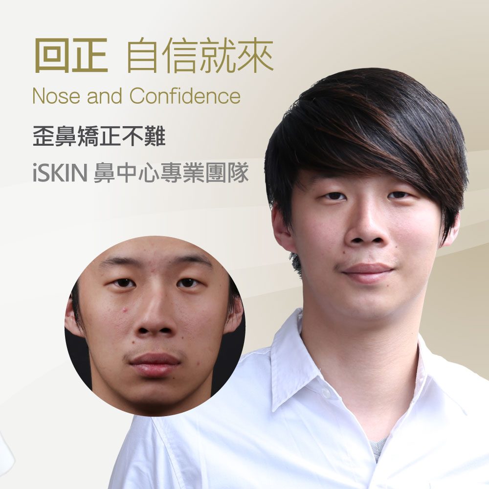 Advertisement banner for iSKIN nasal center titled 'Nose and Confidence,' showing a young man in a white shirt (after) with a circular inset of a before photo.