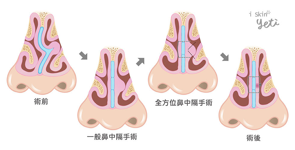 鼻中隔彎曲手術解釋
