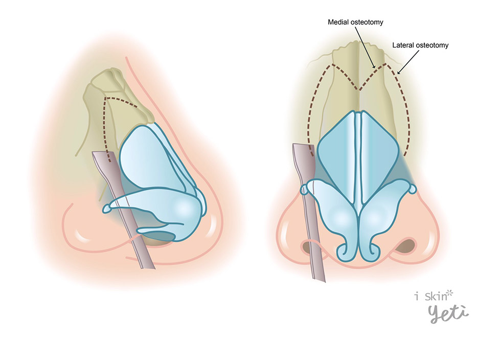 截骨術(Osteotomies)示意圖iSkin