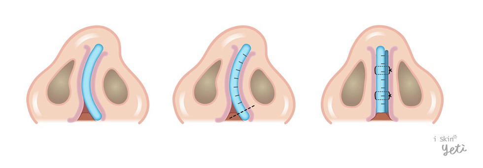 歪鼻­_合併尾端鼻中隔彎曲治療方式鼻中隔旋轉繞道手術(Swinging door maneuver)、軟骨切痕縫合手術(Scoring &Sutures)iSkin