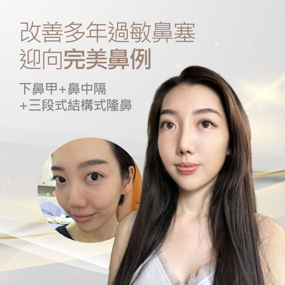 中文宣傳海報：介紹改善多年過敏鼻塞與隆鼻治療；右側為完成治療的女性大頭照，左下有圓形的術前照片，畫面含文字「改善多年過敏鼻塞 迎向完美鼻例 下鼻甲+鼻中隔 +三段式結構式隆鼻」。
