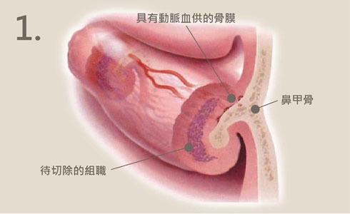 下鼻甲動力旋轉刀手術原理1-iskinnose