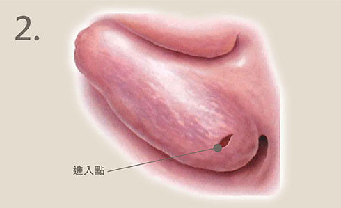 下鼻甲動力旋轉刀手術原理2-iskinnose