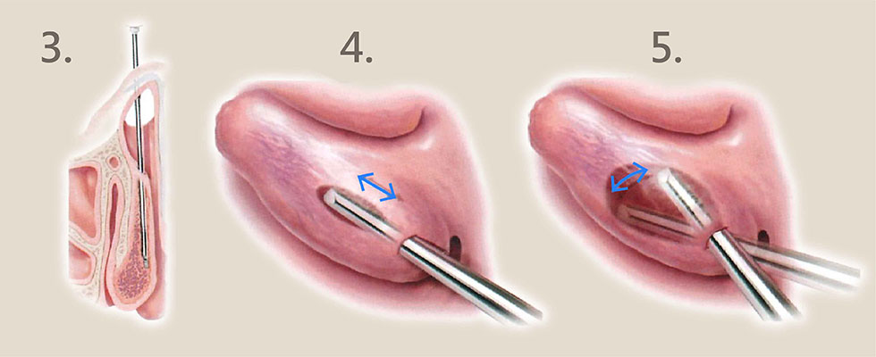 下鼻甲動力旋轉刀手術原理3-iskinnose