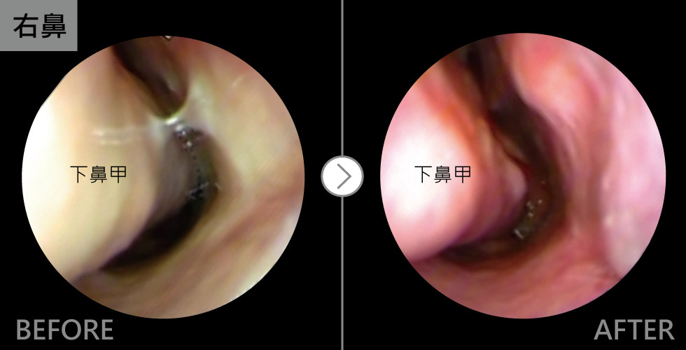 下鼻甲微創術案例分享