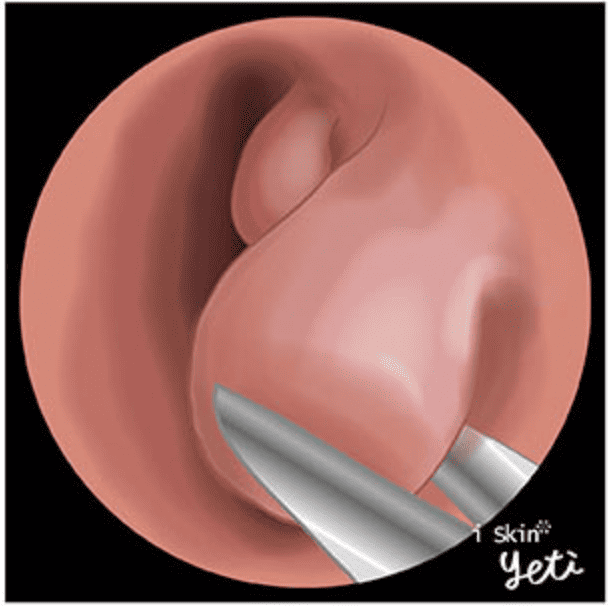 下鼻甲成形手術