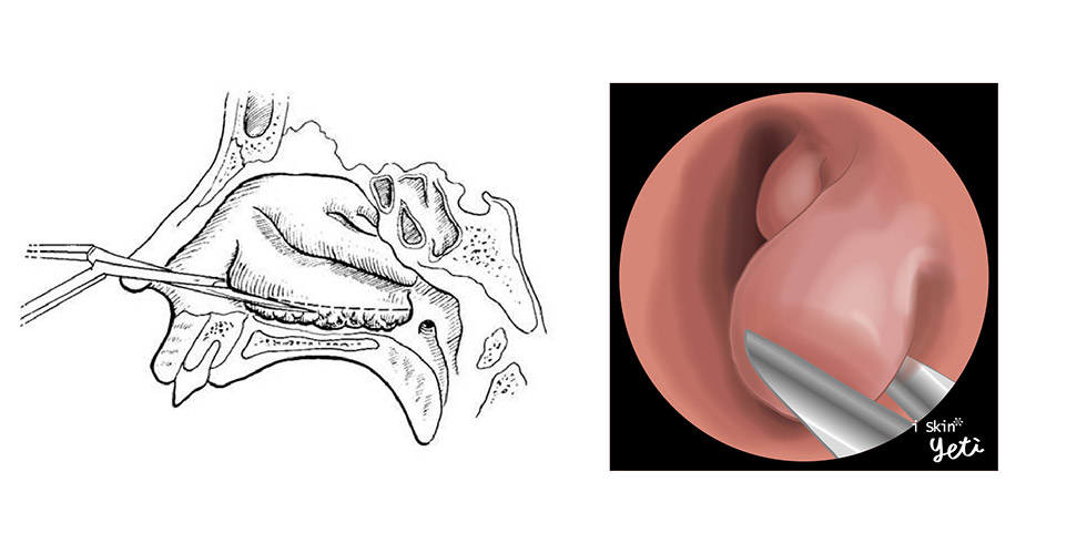 傳統的手術治療下鼻甲-iskinnose