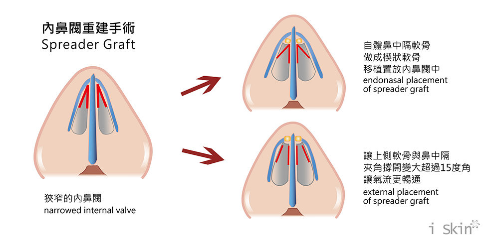 內鼻閥重建手術-iskinnose