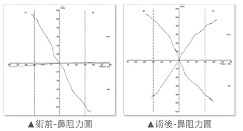 尾端鼻中隔彎曲案例分享3-iskinnose