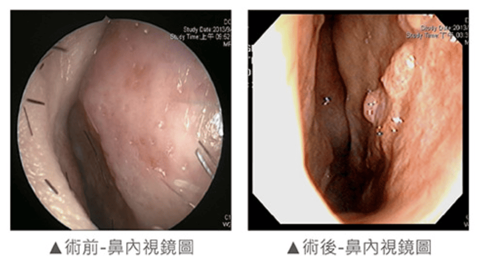 尾端鼻中隔彎曲案例分享4-iskinnose