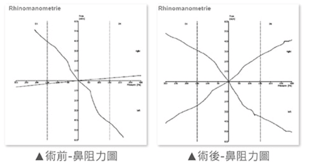 尾端鼻中隔彎曲案例分享5-iskinnose