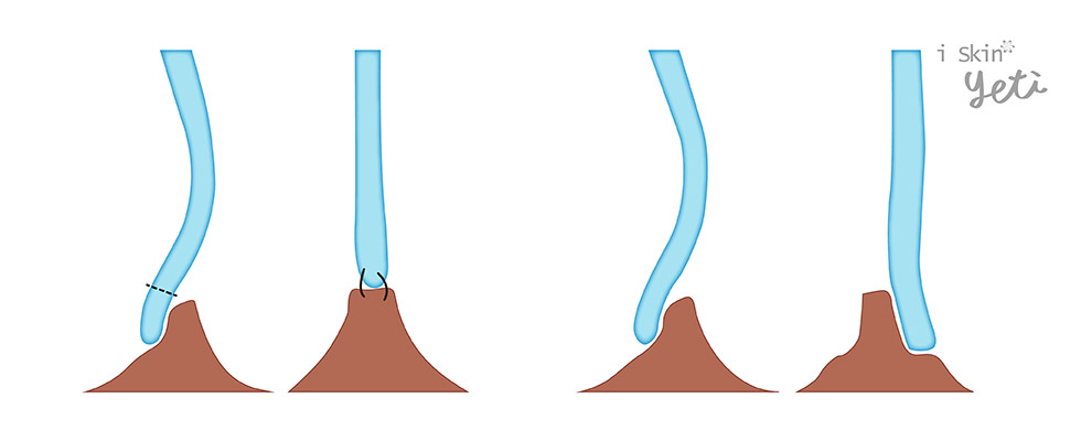 尾端鼻中隔彎曲治療方式1-iskinnose