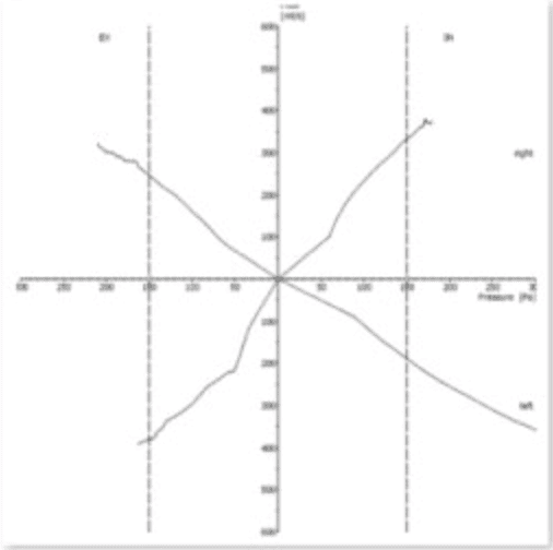 歪鼻案例分享iSkinNose-D小姐-5