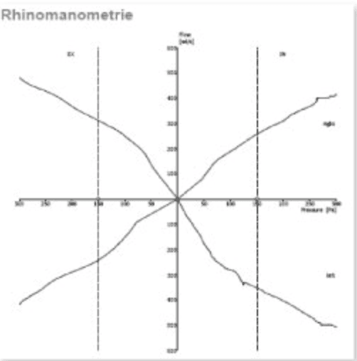 歪鼻案例分享iSkinNoseP先生-6
