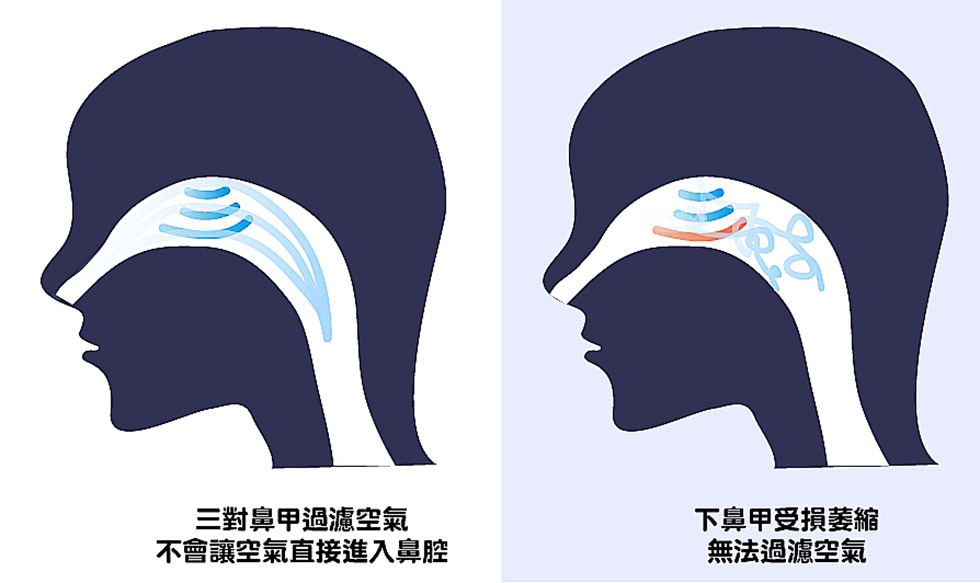 空鼻症呼吸問題-iskinnose