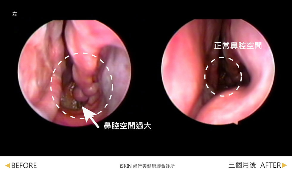 空鼻症案例分享1-iskinnose