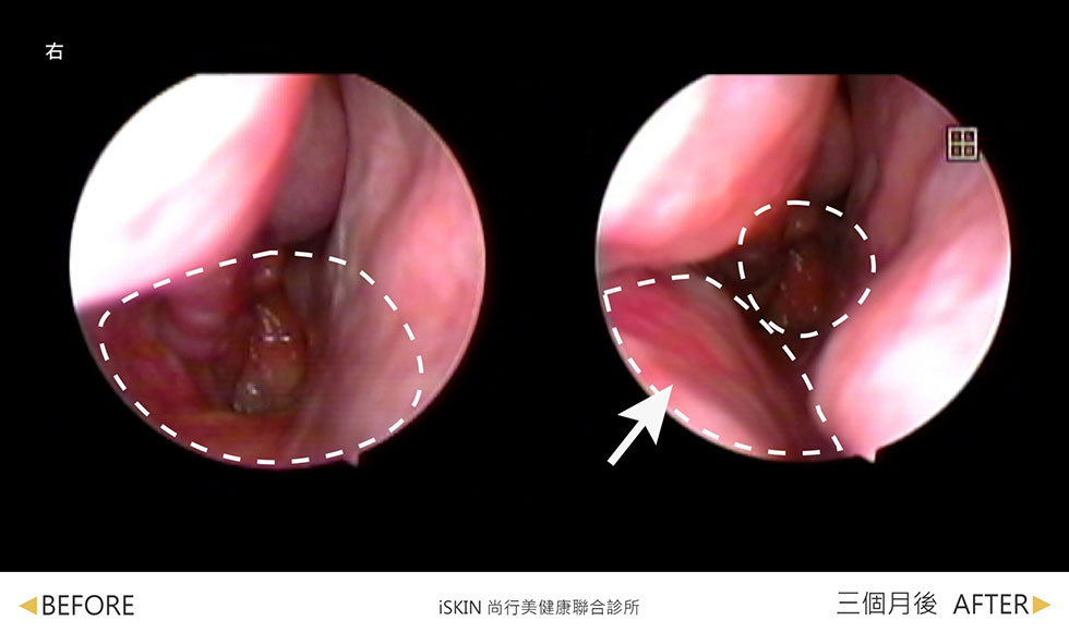 空鼻症案例分享2-iskinnose