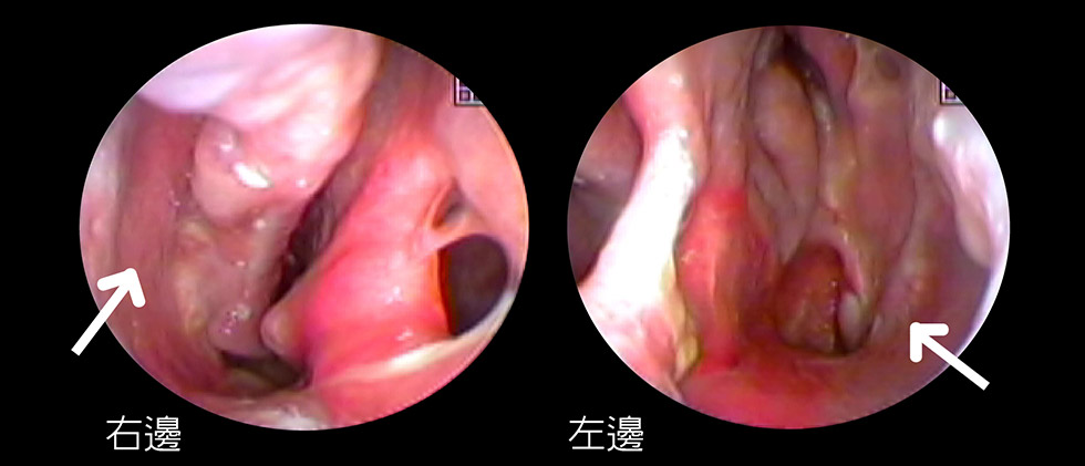 空鼻症案例分享4-iskinnose