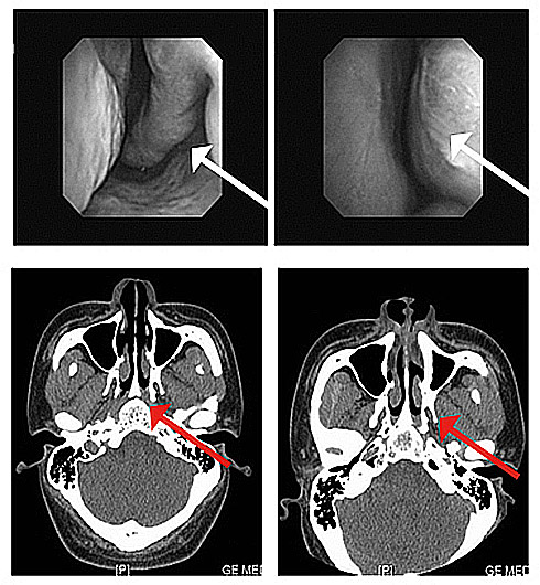 空鼻症重建前後示意圖-iskinnose