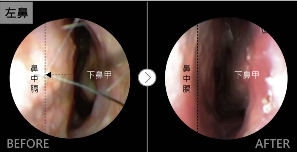 iskinnose鼻中心過敏性鼻炎案例-Vanessa2