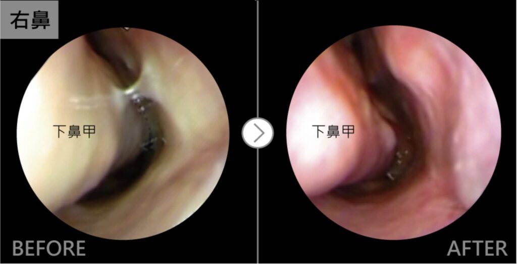 iskinnose鼻中心過敏性鼻炎案例-Vanessa1