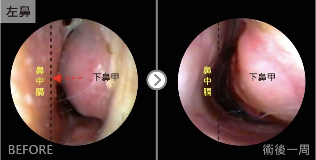 iskinnose鼻中心過敏性鼻炎案例-小馬1