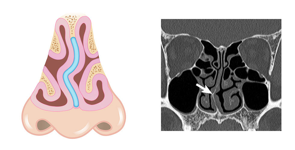 鼻中隔彎曲手術案例X光-iskinnose