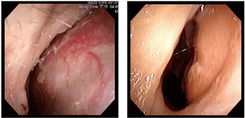 鼻塞治療案例分享iskin
