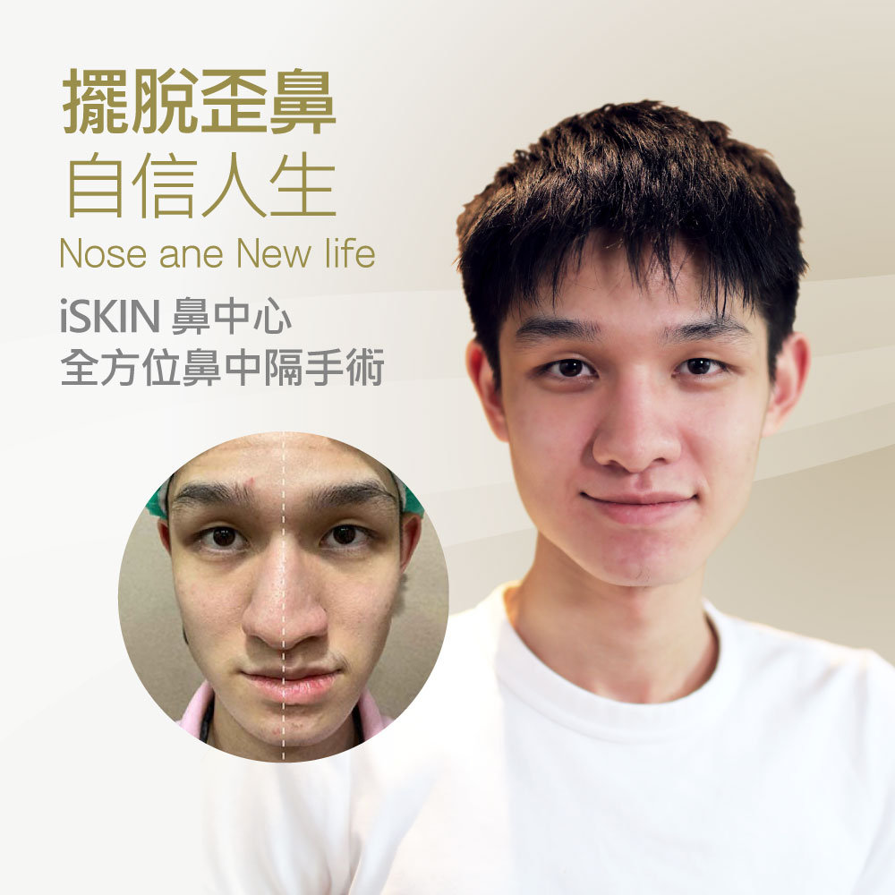 Nose reshaping advertisement: a smiling young man with a circular inset showing a before/after of the nose, promoting iSKIN nasal center and the slogan 'Nose and New Life'