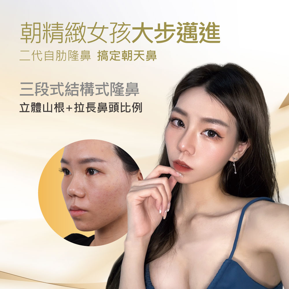 Promotional poster for rhinoplasty showing a woman with makeup; circular before-photo inset to the left and Chinese text advertising a three-stage nose job.