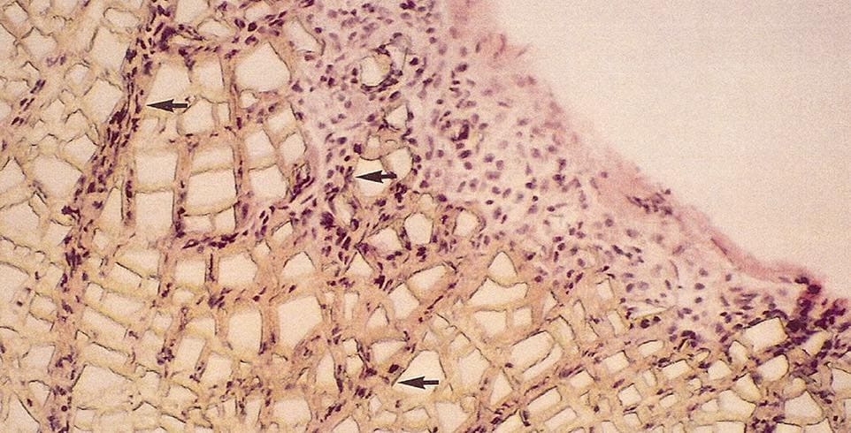 卡麥拉鼻模植入後圖解-iskinnose