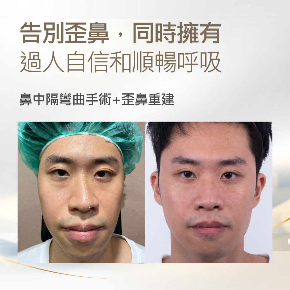 鼻部矫正前后对比图：左侧术前，右侧术后，强调鼻中隔弯曲矫正与呼吸改善并提升自信的效果