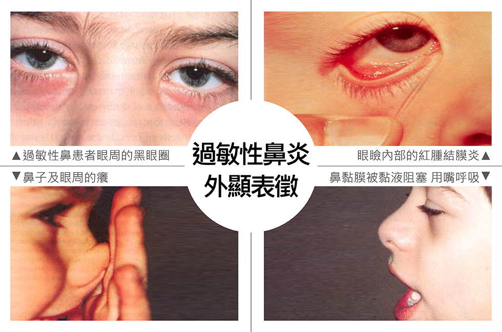過敏性鼻炎的外顯表徵