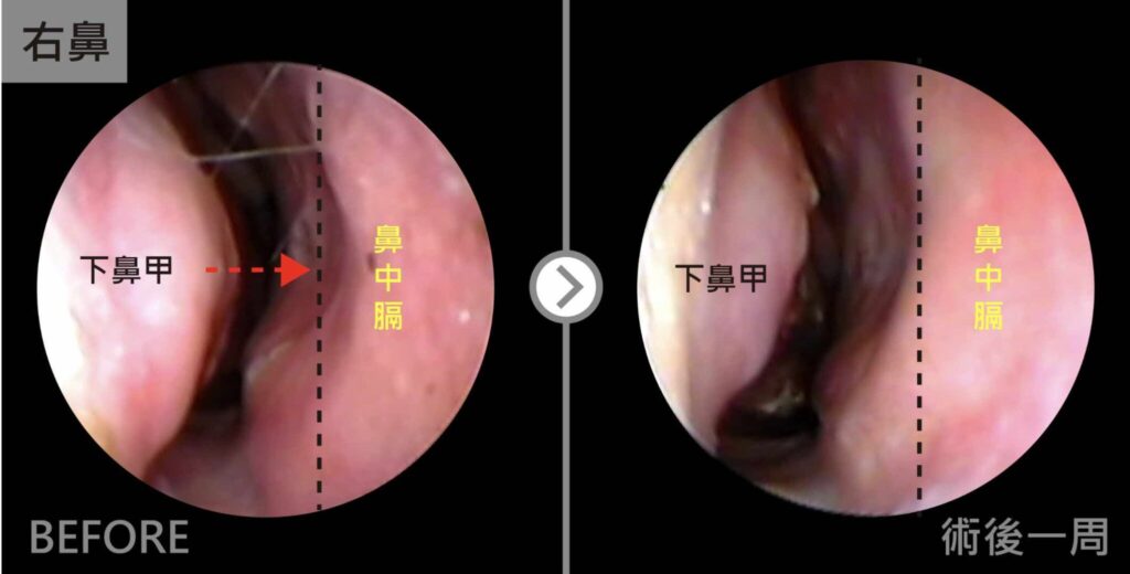 過敏性鼻炎－小馬－2