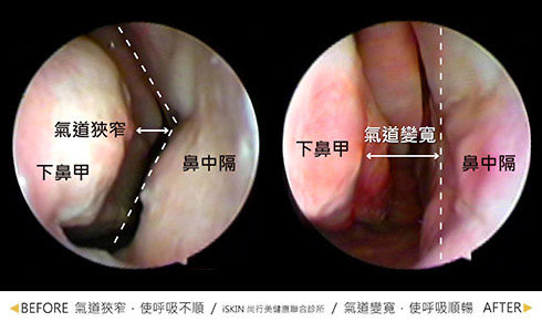 鼻中隔彎曲治療案例３
