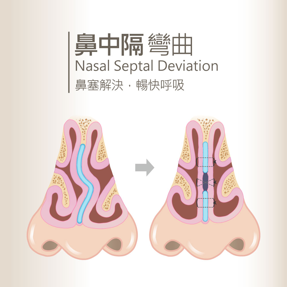 Educational diagram: left shows a deviated nasal septum with a curved blue passage; right shows post-surgery straightened septum with sutures, illustrating septoplasty.