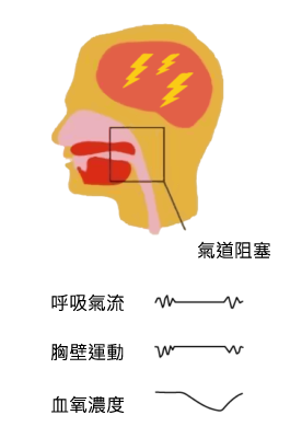中樞型睡眠呼吸中止