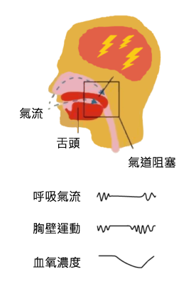 Cross‑section diagram of a head showing the brain with a red pain area and yellow lightning bolts indicating nerve activity, with Japanese labels for parts.