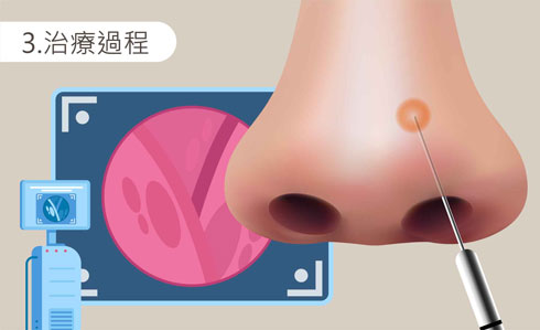 後鼻神經燒灼術step3