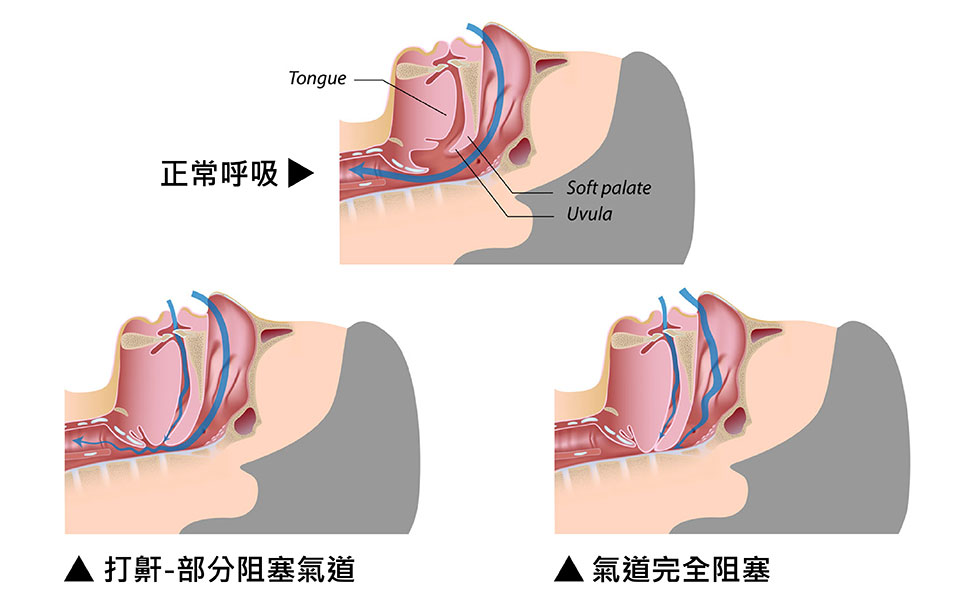 打鼾症狀圖解