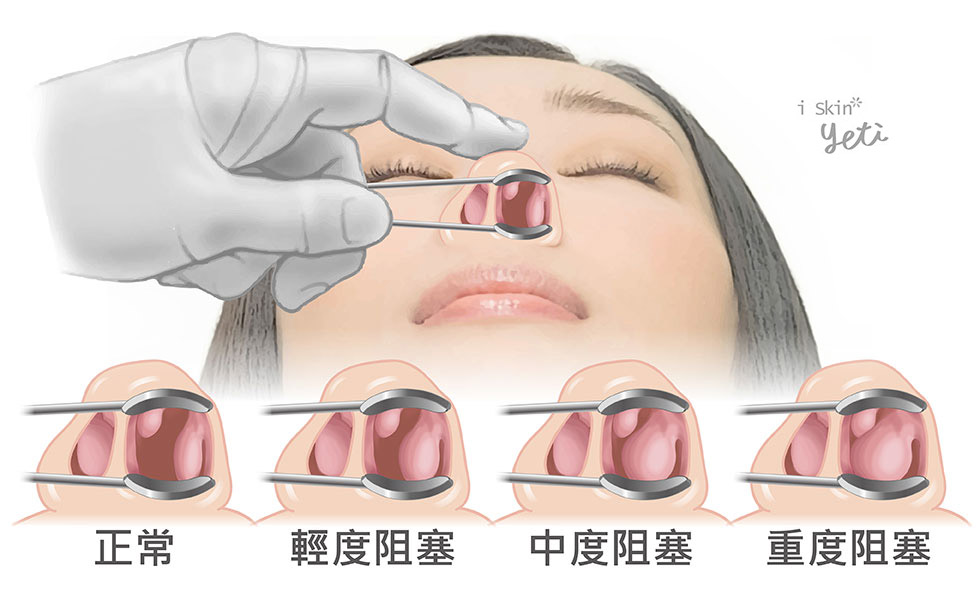 鼻塞阻塞程度